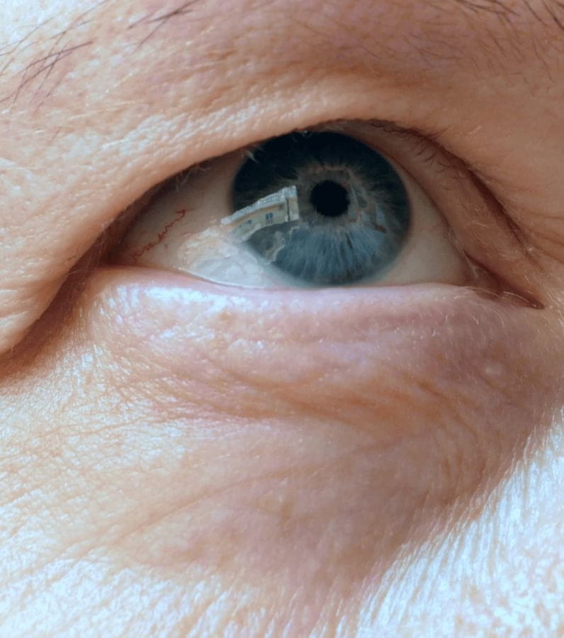 Blépharoplastie supérieure pour les hommes