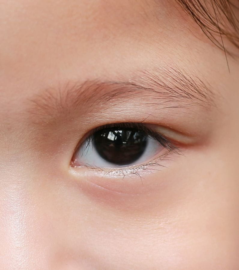 blépharoplastie asiatique