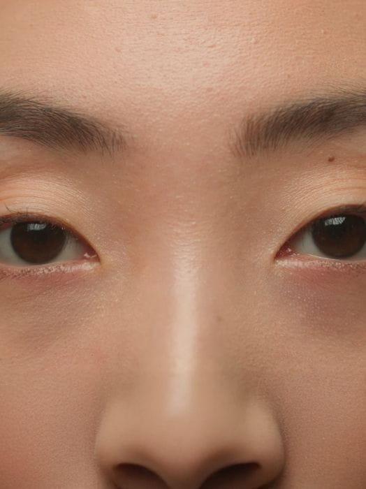 Asian blepharoplasty