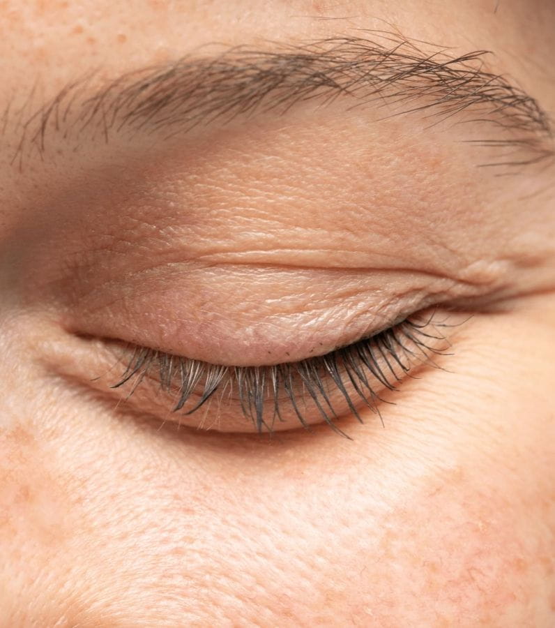 blépharoplastie inférieure poche sous les yeux