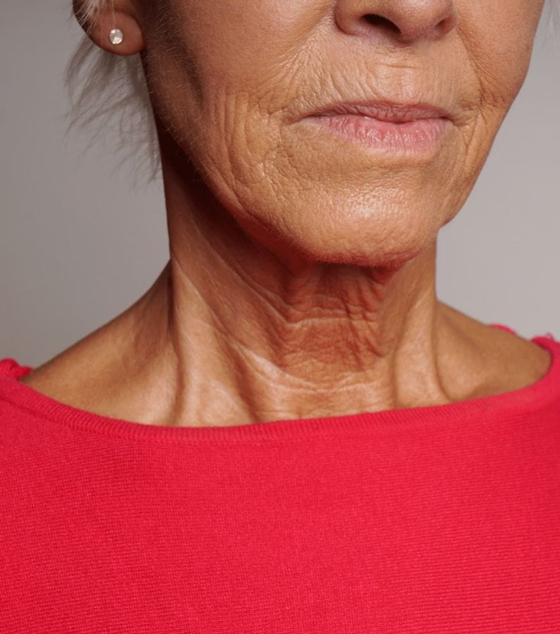 Rajeunissement du visage et du cou à Antibes, Nice et Cannes