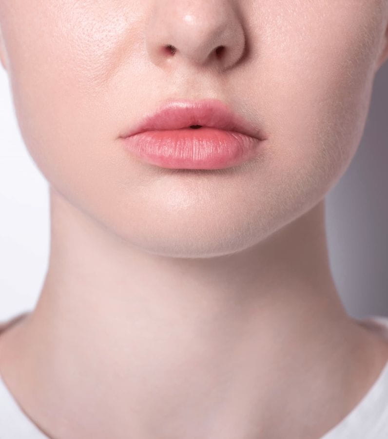 Lifting de la lèvre supérieure - lip lift