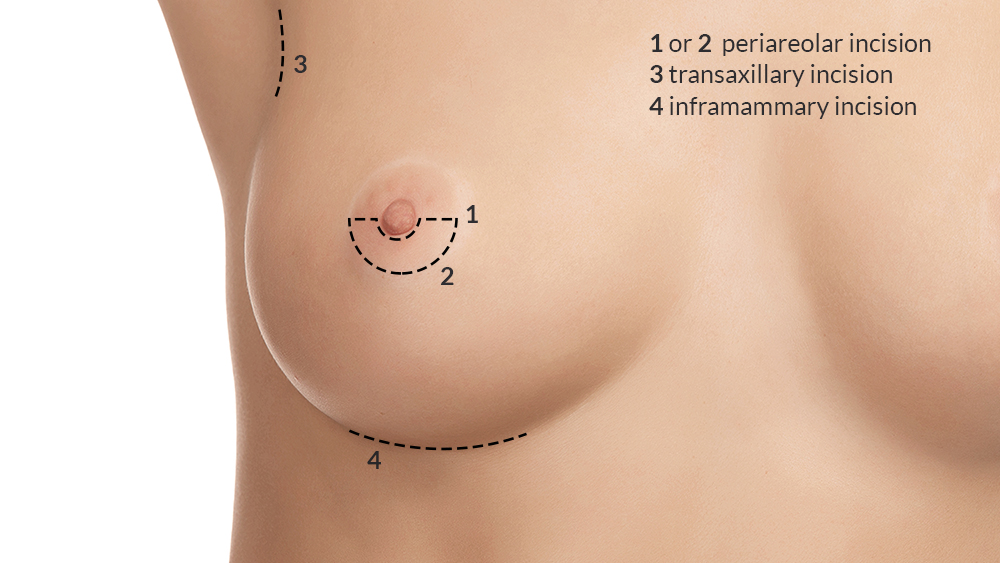 Doctor Merle - Plastic Surgery - Antibes - Breast Augmentation